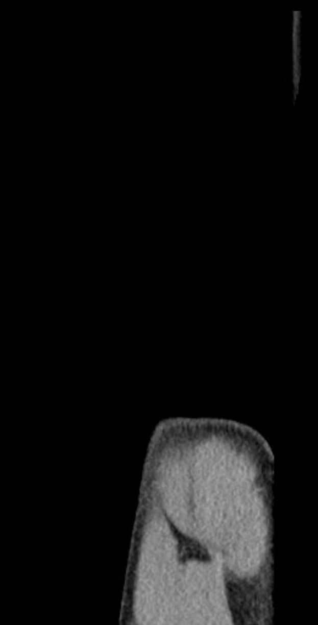 Schwarß-weißer MRI-Aufnahme eines Knies, die detaillierte anatomische Strukturen zeigt.